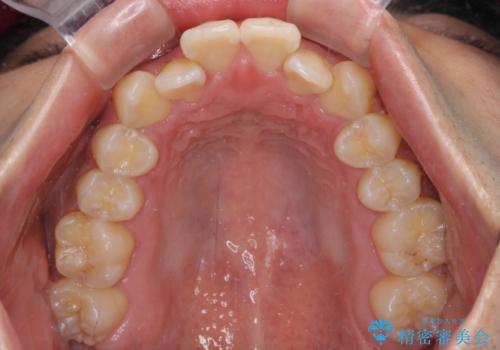 ワイヤー矯正を併用したインビザライン矯正治療の治療前