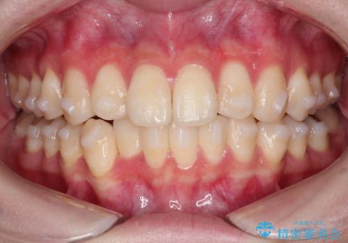 インビザラインによる矯正治療(非抜歯)　前歯の捻れとガタつきの改善の治療中