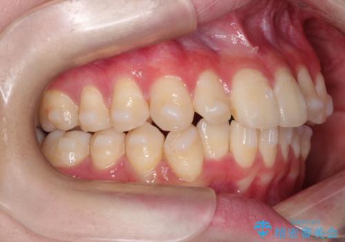 インビザラインによる矯正治療(非抜歯) 前歯の捻れとガタつきの改善の治療中