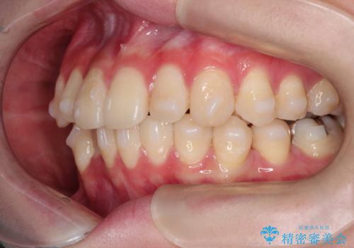 インビザラインによる矯正治療(非抜歯) 前歯の捻れとガタつきの改善の治療中