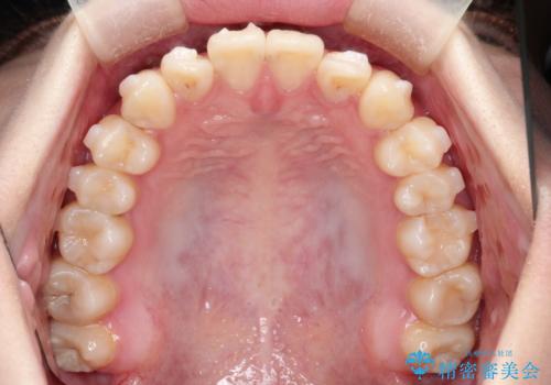 インビザラインによる矯正治療(非抜歯)　前歯の捻れとガタつきの改善の治療中