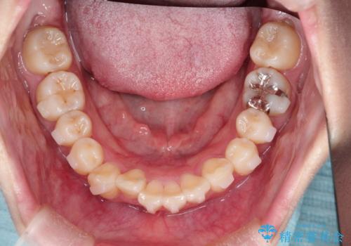 インビザラインによる矯正治療(非抜歯) 前歯の捻れとガタつきの改善の治療中