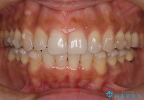 インビザラインで自然な美しさへ、前歯のガタツキを改善しましたの治療中