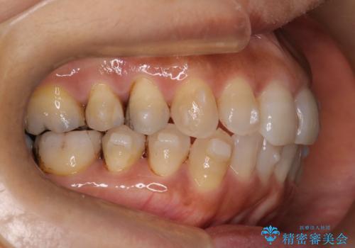 インビザラインで自然な美しさへ、前歯のガタツキを改善しましたの治療中