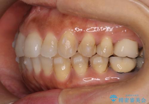インビザラインで自然な美しさへ、前歯のガタツキを改善しましたの治療中
