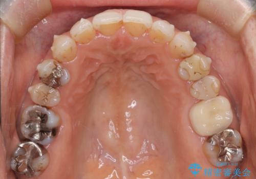 インビザラインで自然な美しさへ、前歯のガタツキを改善しましたの治療中