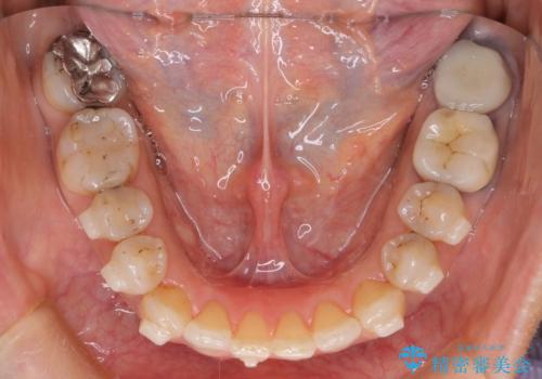 インビザラインで自然な美しさへ、前歯のガタツキを改善しましたの治療中