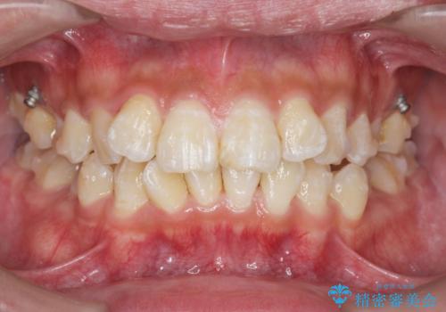 遠心移動を伴うマウスピース非抜歯矯正治療の治療中