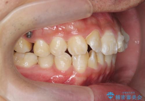 遠心移動を伴うマウスピース非抜歯矯正治療の治療中