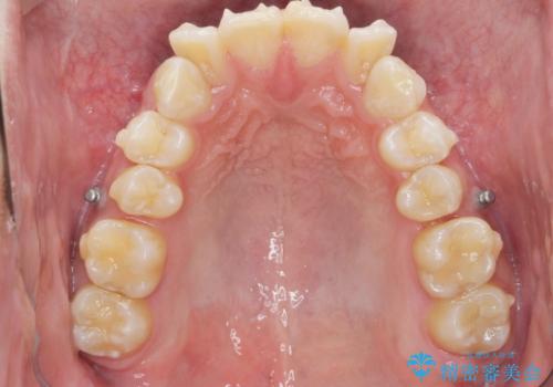 遠心移動を伴うマウスピース非抜歯矯正治療の治療中