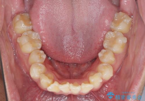 遠心移動を伴うマウスピース非抜歯矯正治療の治療中