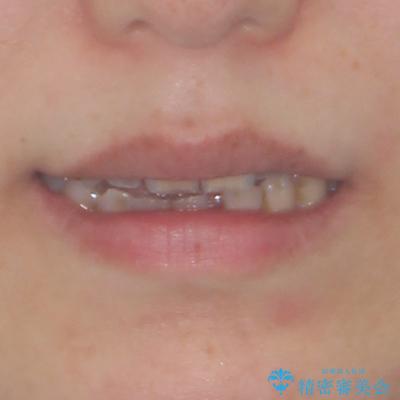 開咬と歯の欠損 ワイヤー装置を併用したインビザライン矯正治療の治療前(顔貌)