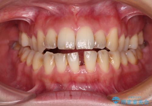開咬と歯の欠損　ワイヤー装置を併用したインビザライン矯正治療の症例 治療前