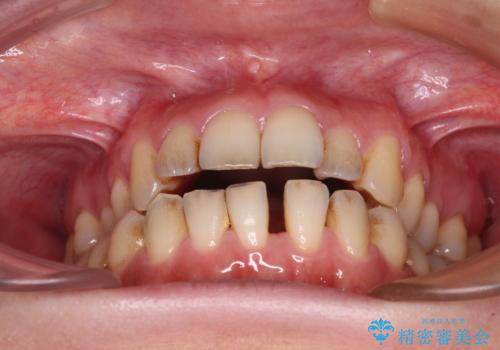 開咬と歯の欠損 ワイヤー装置を併用したインビザライン矯正治療の治療前