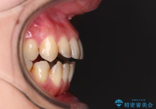開咬と歯の欠損 ワイヤー装置を併用したインビザライン矯正治療の治療前