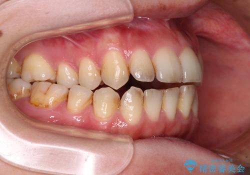 開咬と歯の欠損　ワイヤー装置を併用したインビザライン矯正治療の治療前