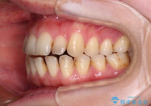 開咬と歯の欠損 ワイヤー装置を併用したインビザライン矯正治療の治療前
