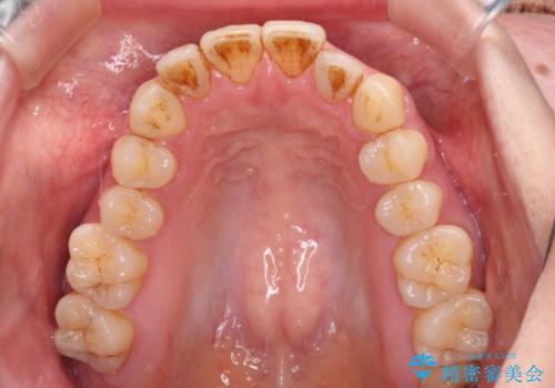 開咬と歯の欠損 ワイヤー装置を併用したインビザライン矯正治療の治療前