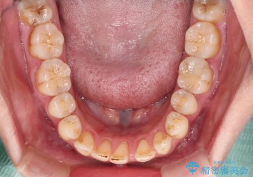 開咬と歯の欠損　ワイヤー装置を併用したインビザライン矯正治療の治療前