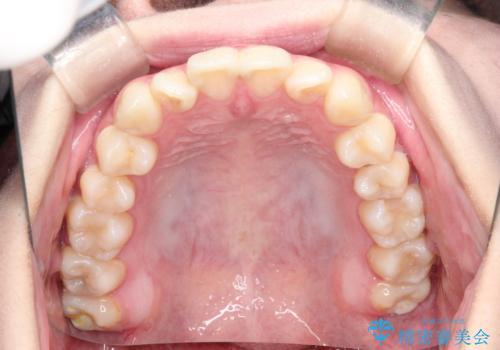 インビザラインによる矯正治療(非抜歯) 前歯の捻れとガタつきの改善の治療前