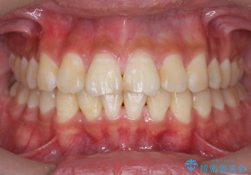 非抜歯(歯を抜かない)の症例 治療後