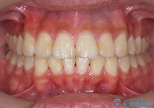 遠心移動を伴うマウスピース非抜歯矯正治療の症例 治療後