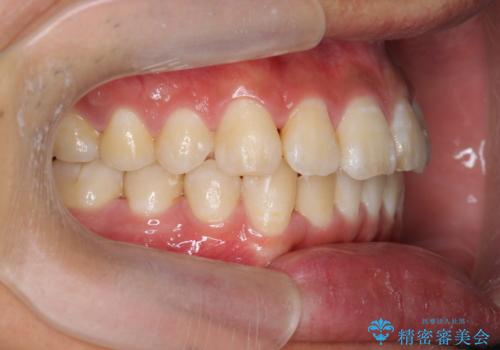 遠心移動を伴うマウスピース非抜歯矯正治療の治療後