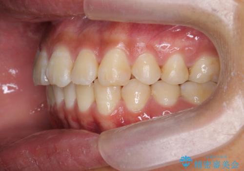 遠心移動を伴うマウスピース非抜歯矯正治療の治療後