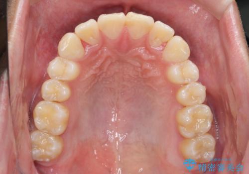 遠心移動を伴うマウスピース非抜歯矯正治療の治療後