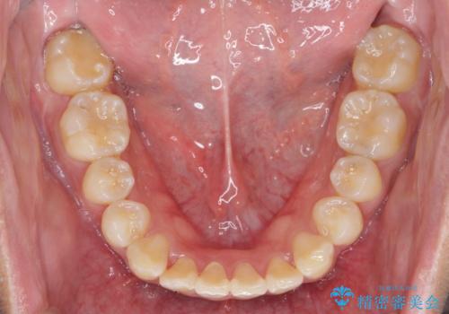 遠心移動を伴うマウスピース非抜歯矯正治療の治療後