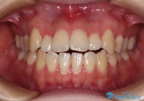 舌突出癖による開咬　舌のトレーニングを行いながら前歯の隙間を改善の症例 治療前