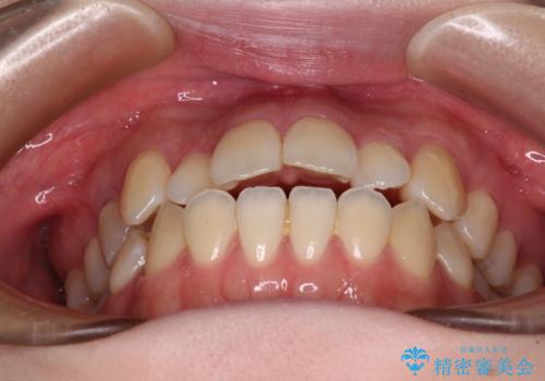 舌突出癖による開咬 舌のトレーニングを行いながら前歯の隙間を改善の治療前