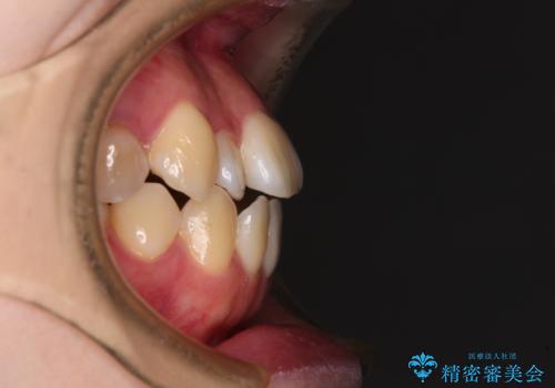 舌突出癖による開咬 舌のトレーニングを行いながら前歯の隙間を改善の治療前