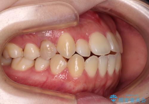 舌突出癖による開咬　舌のトレーニングを行いながら前歯の隙間を改善の治療前