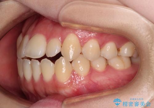 舌突出癖による開咬 舌のトレーニングを行いながら前歯の隙間を改善の治療前