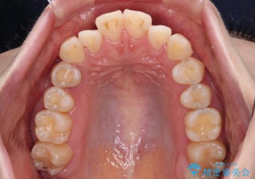 舌突出癖による開咬 舌のトレーニングを行いながら前歯の隙間を改善の治療前