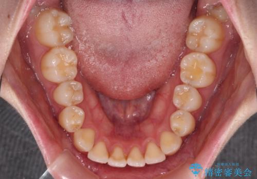 舌突出癖による開咬　舌のトレーニングを行いながら前歯の隙間を改善の治療前