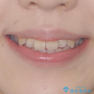 舌突出癖による開咬　舌のトレーニングを行いながら前歯の隙間を改善の治療前（顔貌）