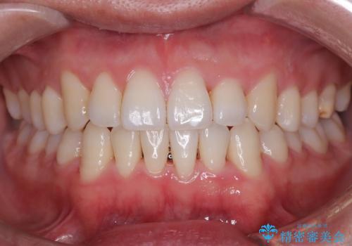 笑顔が魅力的に変わる! インビザライン矯正で前歯のすきっぱを改善しましたの症例 治療後