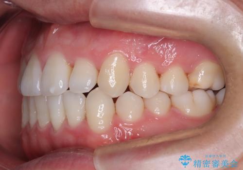 笑顔が魅力的に変わる! インビザライン矯正で前歯のすきっぱを改善しましたの治療後