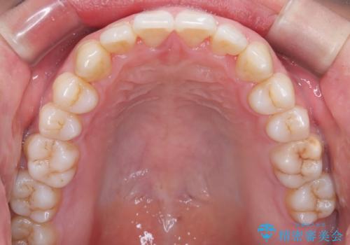 笑顔が魅力的に変わる! インビザライン矯正で前歯のすきっぱを改善しましたの治療後