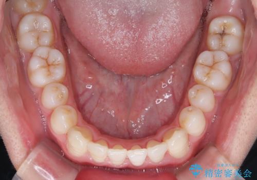 笑顔が魅力的に変わる! インビザライン矯正で前歯のすきっぱを改善しましたの治療後