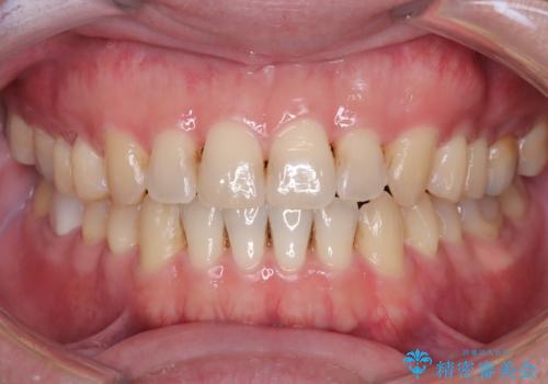 マウスピース矯正で自然な笑顔を実現! 前歯の咬み合わせを治しました。の症例 治療後