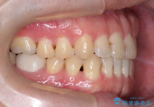 マウスピース矯正で自然な笑顔を実現! 前歯の咬み合わせを治しました。の治療後