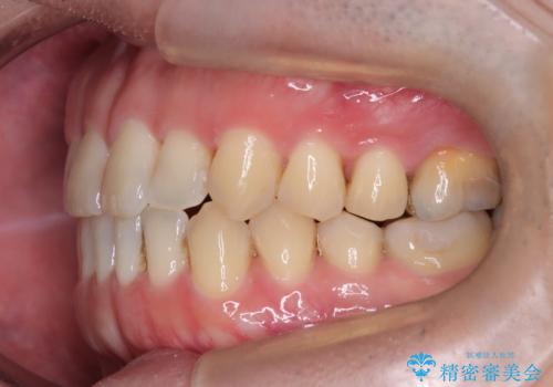 マウスピース矯正で自然な笑顔を実現! 前歯の咬み合わせを治しました。の治療後