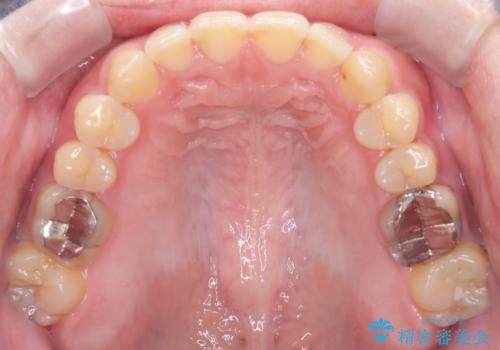マウスピース矯正で自然な笑顔を実現! 前歯の咬み合わせを治しました。の治療後