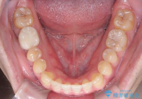 マウスピース矯正で自然な笑顔を実現! 前歯の咬み合わせを治しました。の治療後