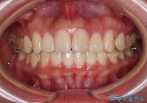 飛び出した上顎前歯 インビザラインで引っ込めるの治療中