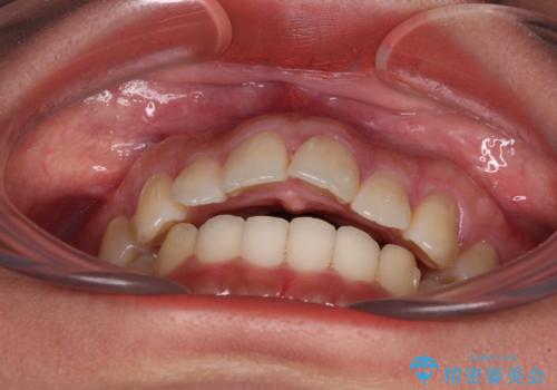 飛び出した上顎前歯 インビザラインで引っ込めるの治療中