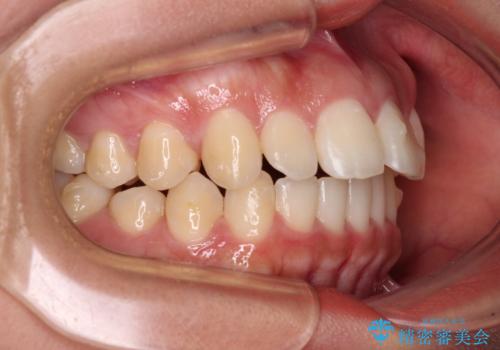 飛び出した上顎前歯 インビザラインで引っ込めるの治療中